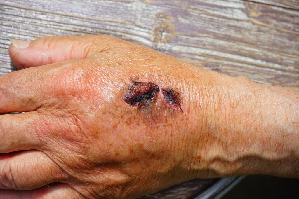 hand, injury, skin abrasion-474279.jpg